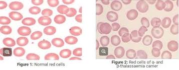 THALASSAEMIA MINOR OR TRAIT