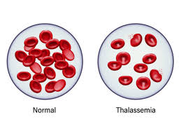 What is thalassemia – Parents Association – Thalassemic Unit Trust Mumbai